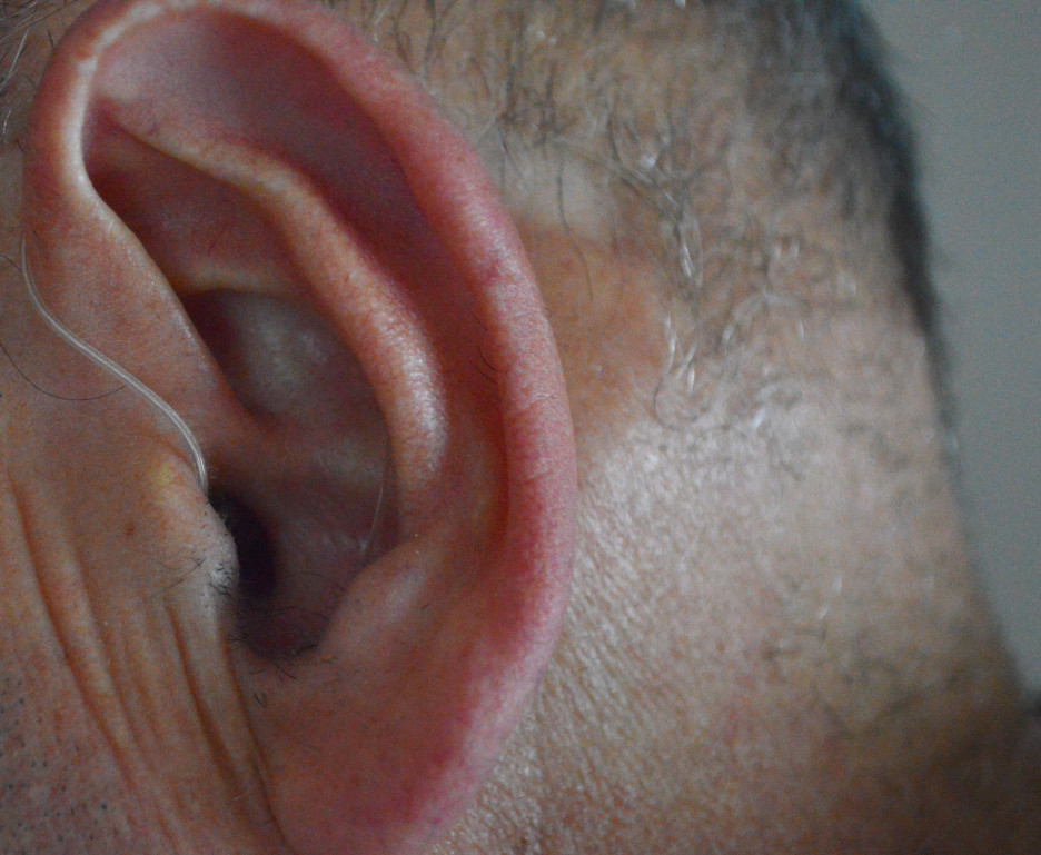 une infection de l'oreille
